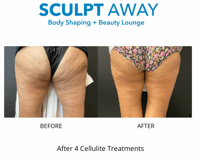 Cellulite Therapy San Antonio